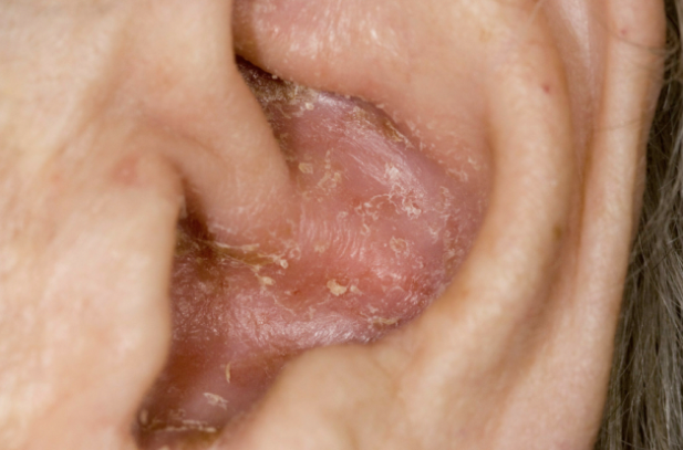 Schimmel in het oor: wat het is en wat kun je eraan kunt doen